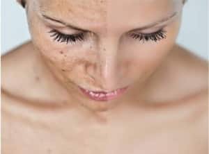 Desmancha tu piel al natural